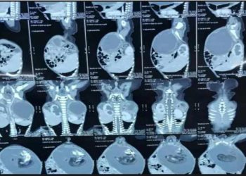 7 माह के बच्चे के पेट से निकला एक और बच्चा, डॉक्टर बोले- काफी दुर्लभ मामला