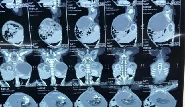 7 माह के बच्चे के पेट से निकला एक और बच्चा, डॉक्टर बोले- काफी दुर्लभ मामला