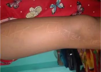 बच्ची के शरीर पर उभर रहा कभी राम-राम तो कभी राधे-राधे, कभी देवी-देवताओं के नाम, हर कोई हैरान