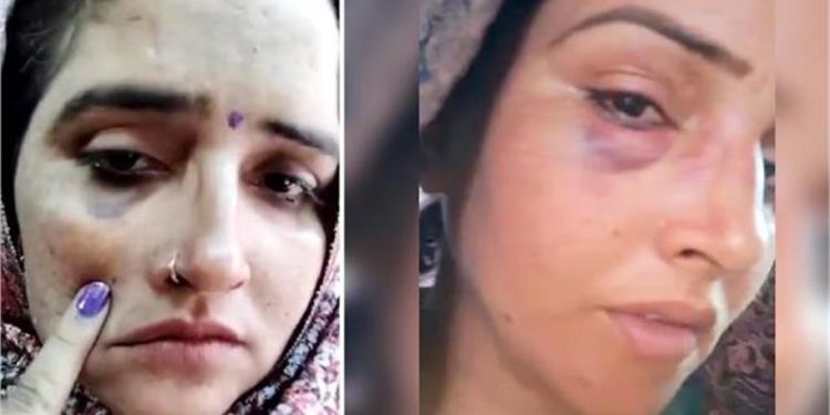 Seema Haider ने अपने चेहरे पर दिखाए जख्मों के निशान, क्या पति सचिन ने कर दी मारपीट? वकील ने बताई पूरी सच्चाई