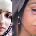 Seema Haider ने अपने चेहरे पर दिखाए जख्मों के निशान, क्या पति सचिन ने कर दी मारपीट? वकील ने बताई पूरी सच्चाई