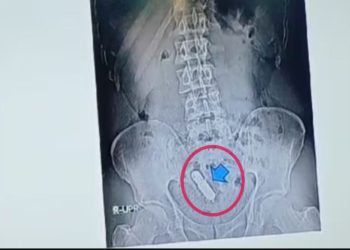 UP: शख्स के पेट में हो रहा था दर्द, X-ray कराया तो निकला सेक्स टॉय