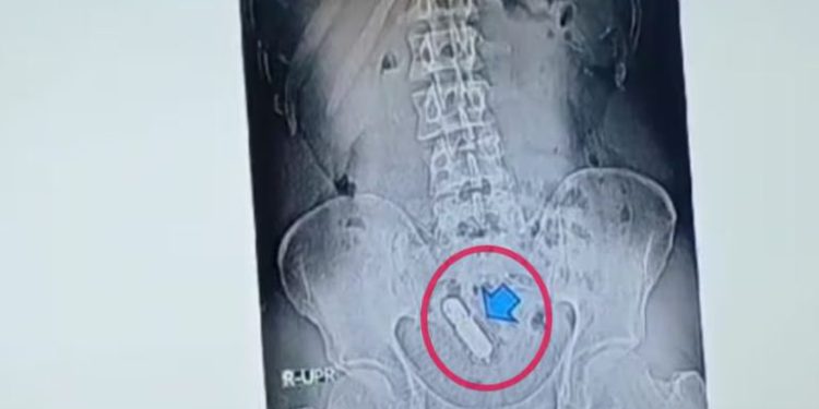 UP: शख्स के पेट में हो रहा था दर्द, X-ray कराया तो निकला सेक्स टॉय