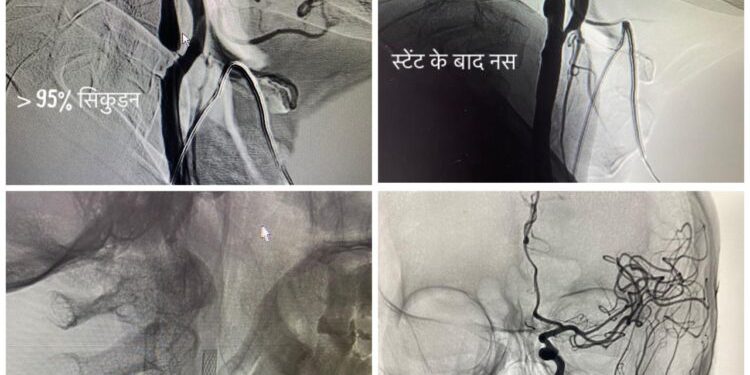 AIIMS ऋषिकेश में भी ब्रेन व स्पाइन की खून की नसों की बीमारियों का बिना चीरफाड़ के उपचार